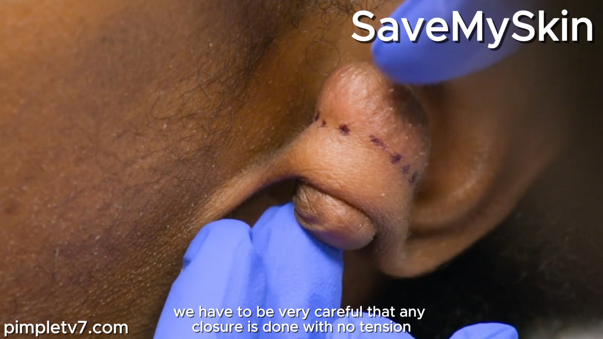 Convinced the diagnosis is wrong, she turns to Dr. Emma for answers. SaveMySkin 150926