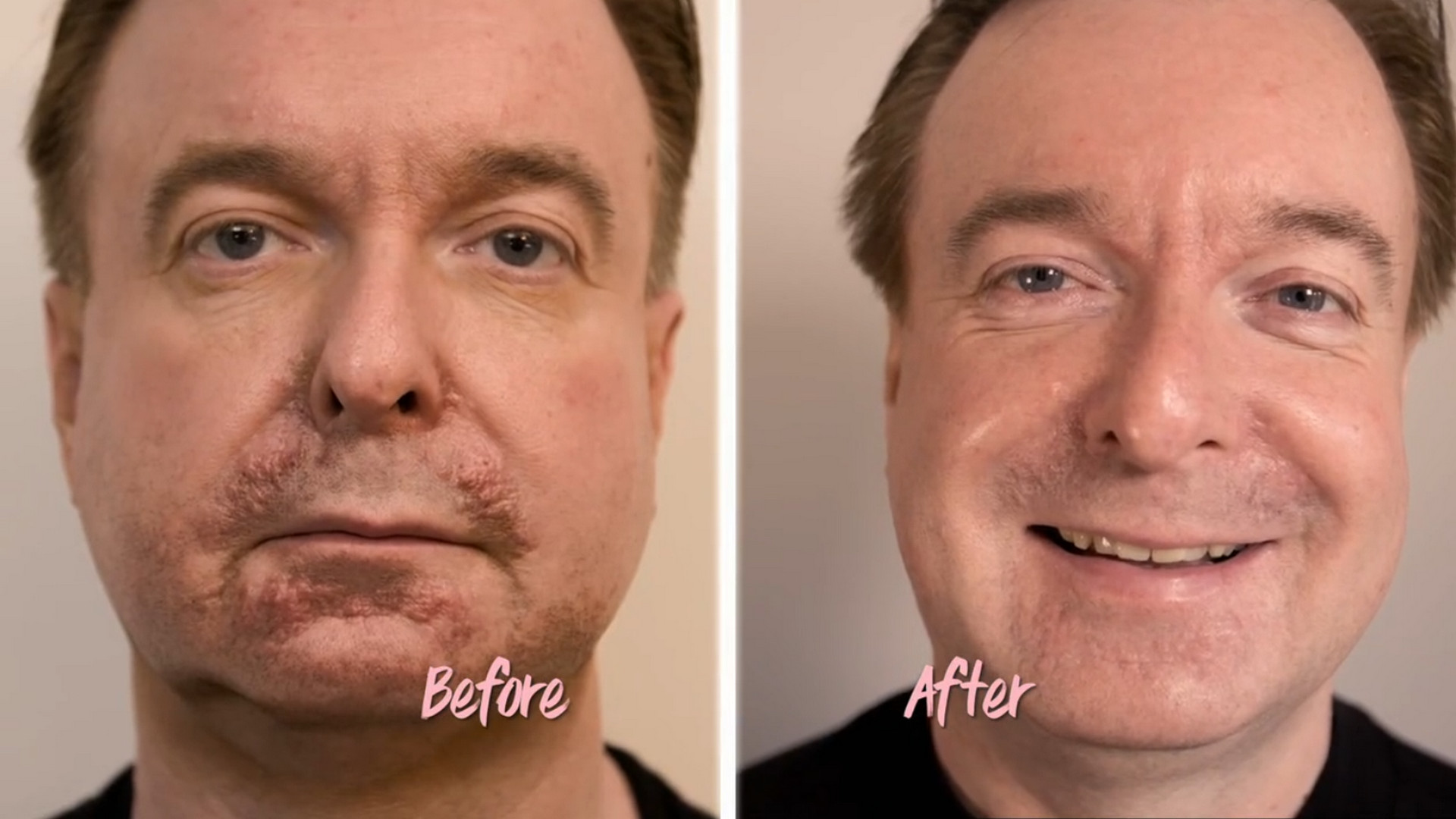David had a small lump around the area of his mouth about ten years ago. SaveMySkin 170926