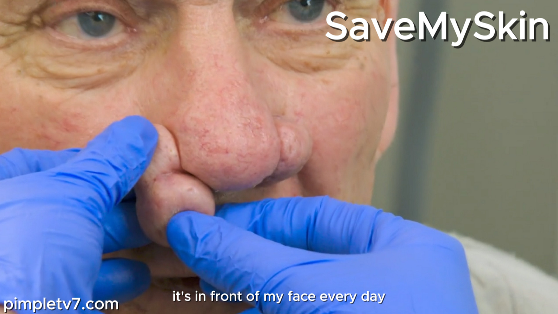 David is devastated by the large lumps on his nose, which are obstructing his breathing. SaveMySkin 190926