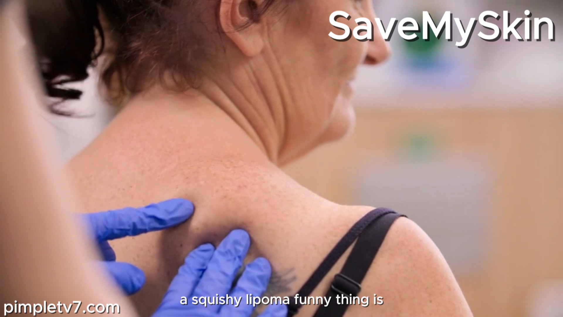 Dawn’s desperate to get rid of her huge lipoma and inject the fun back into her life. SaveMySkin 050926