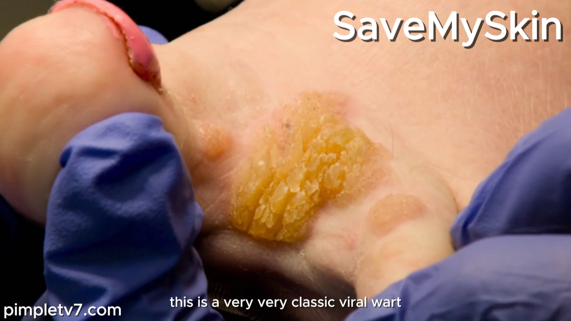 Dr. Emma has an ingenious plan to get rid of the huge wart on Sian’s foot. SaveMySkin 140926