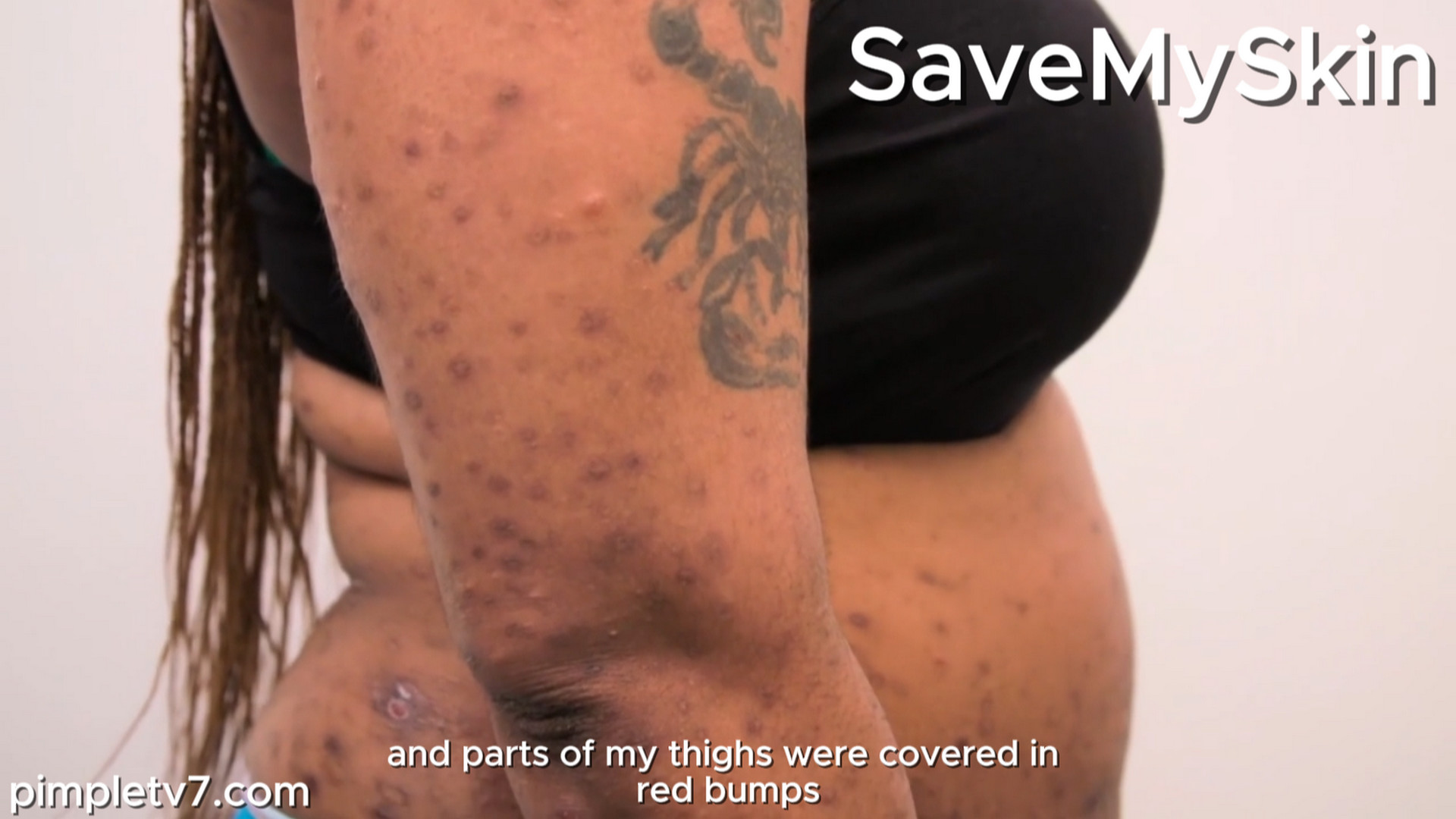 Dr. Emma meets Kyla, who suffers with pus-filled lesions all over her body. SaveMySkin 120926