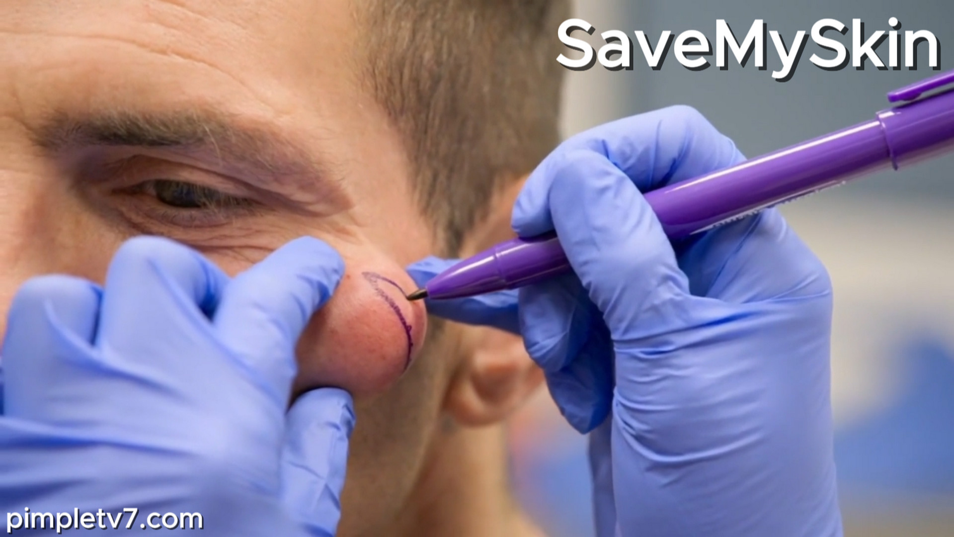 Dr. Emma tackles a large golf ball-sized cyst on Dave’s cheek that is ruining his life. SaveMySkin 070926