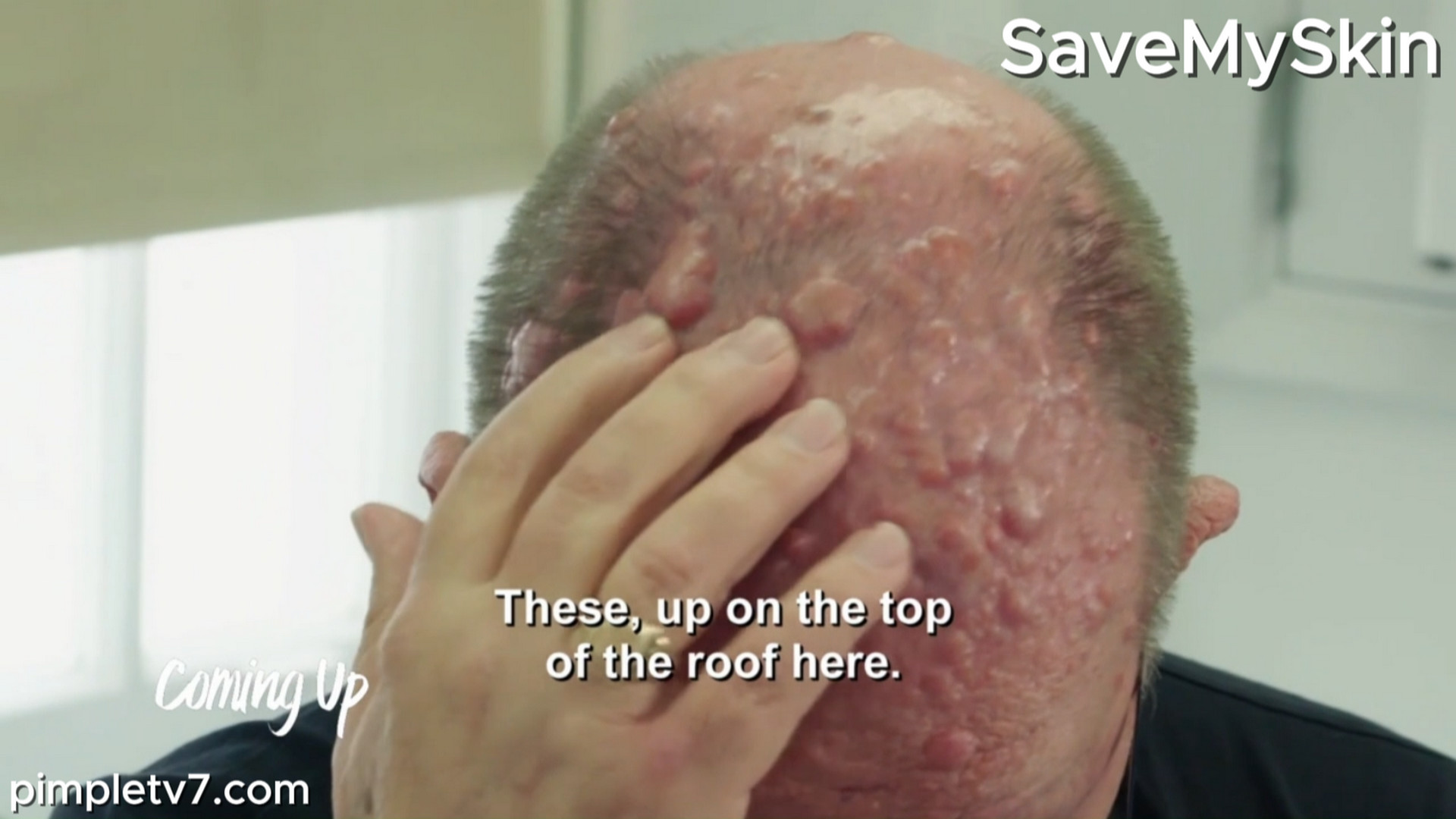 Dr. Emma performs the newly named “Victor Technique” on a man plagued by bumps. SaveMySkin 050926