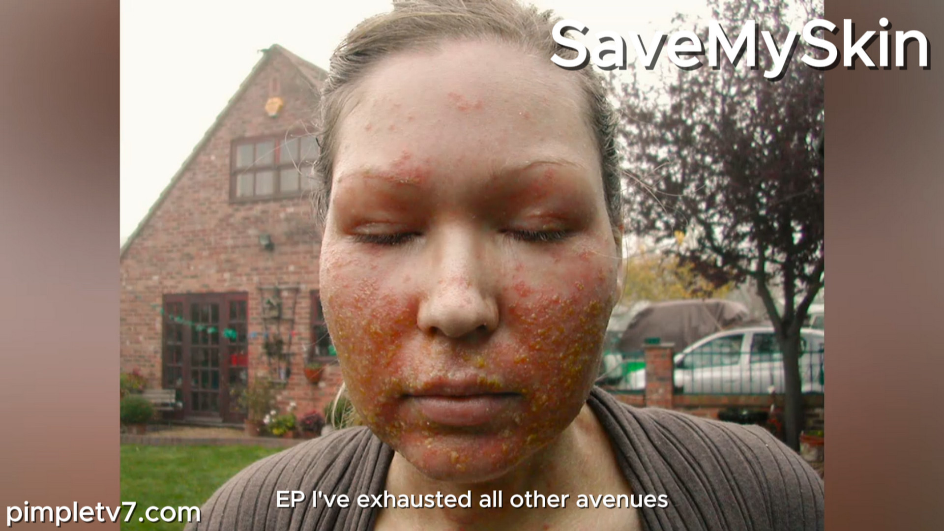 Lumpy skin condition on Zoe’s face. SaveMySkin 250926