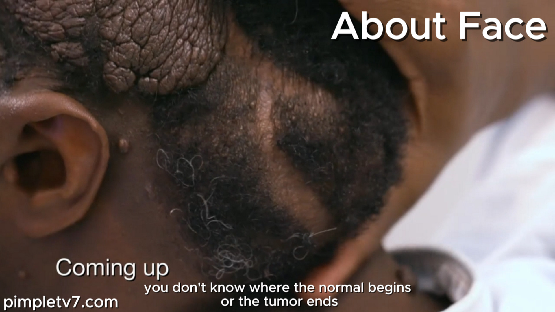 Dr. Panossian and Dr. Rovelo join forces to remove a massive tumor that has wrapped man’s head. AboutFace 200926