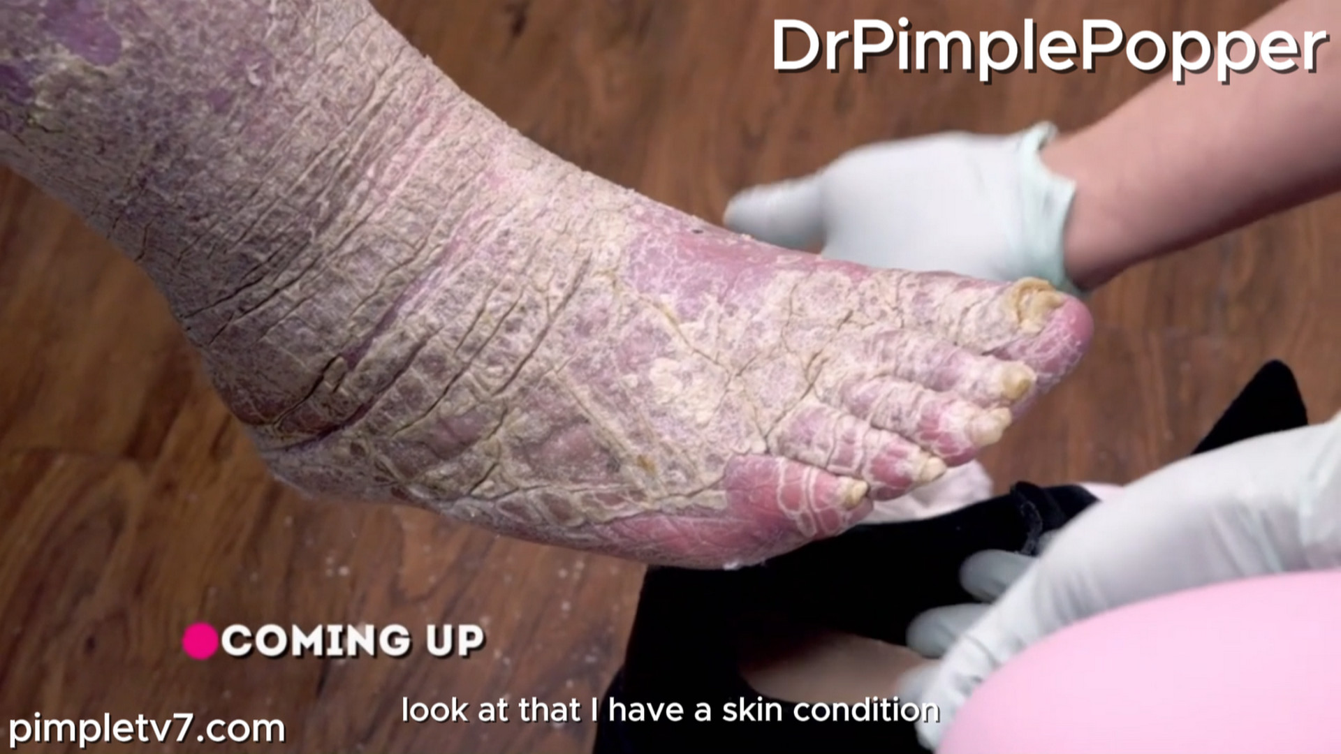 Dr. Sandra Lee assists Louis, who is covered in scaly, dry skin that makes him feel like an alligator. Dr. Pimple Popper 120926