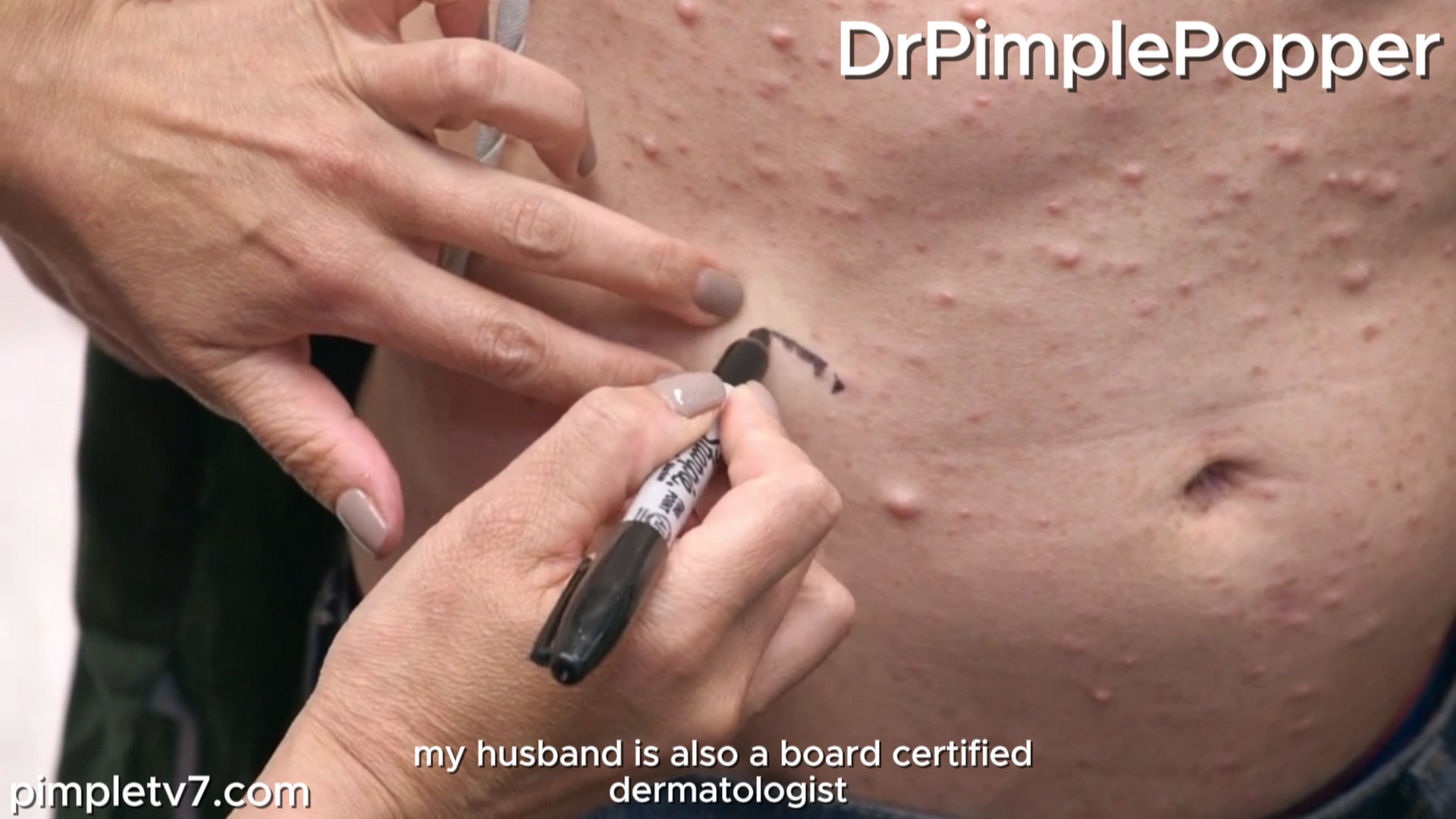 Dr. Sandra Lee assists Matt with a skin condition that causes tumors to grow all over his body. Dr. Pimple Popper 090926