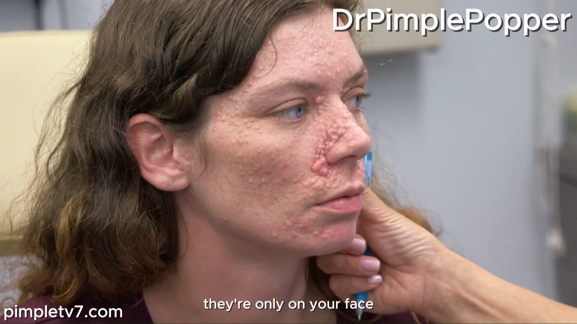 Dr. Sandra Lee helps Amber, who has hundreds of tumors on her face. Dr. Pimple Popper 120926