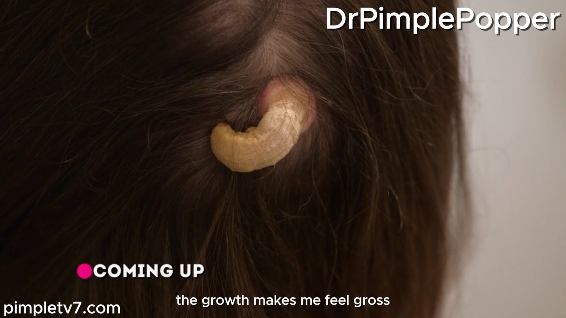 Dr. Sandra Lee helps Lisa, who has a horn growing out of the back of her head and fears that it could be cancer.  Dr. Pimple Popper 160926