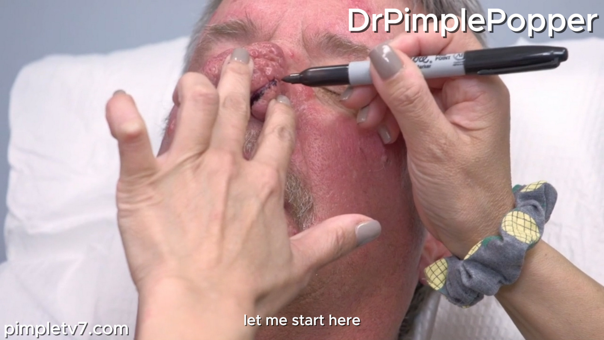 Dr. Sandra Lee helps Patrick with huge bumps covering his nose. Dr. Pimple Popper 150926