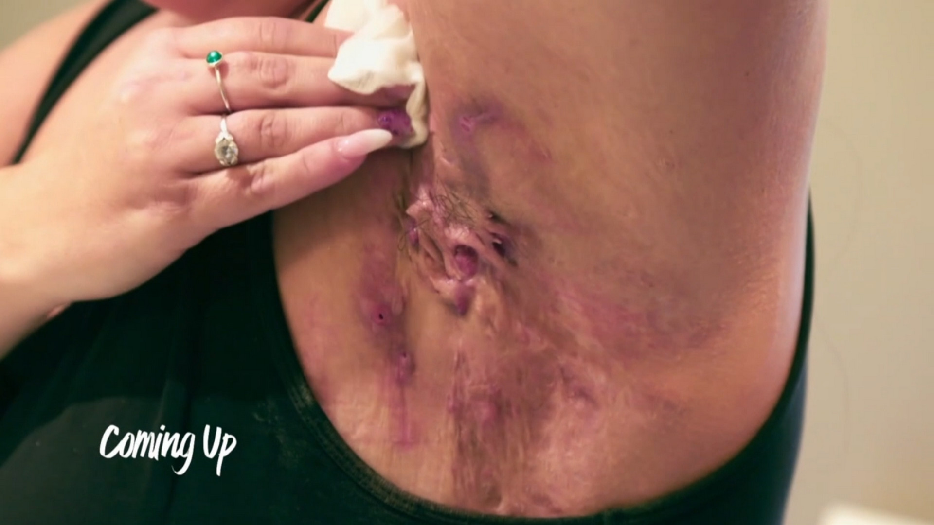 Elise is tormented by leaking abscesses and lesions that then burst. SaveMySkin 040926
