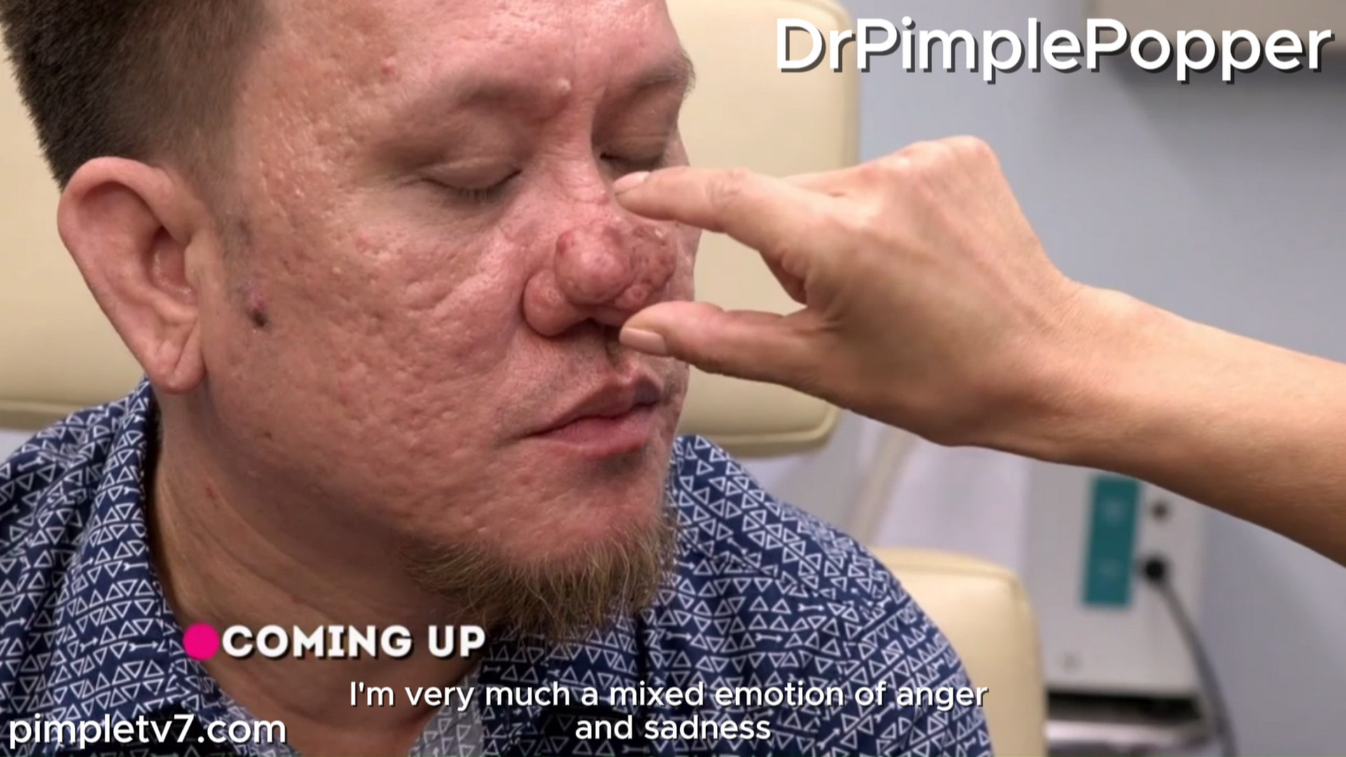 Genner has flown all the way from the Philippines to have Dr. Lee help with his bumpy nose. Dr. Pimple Popper 060926