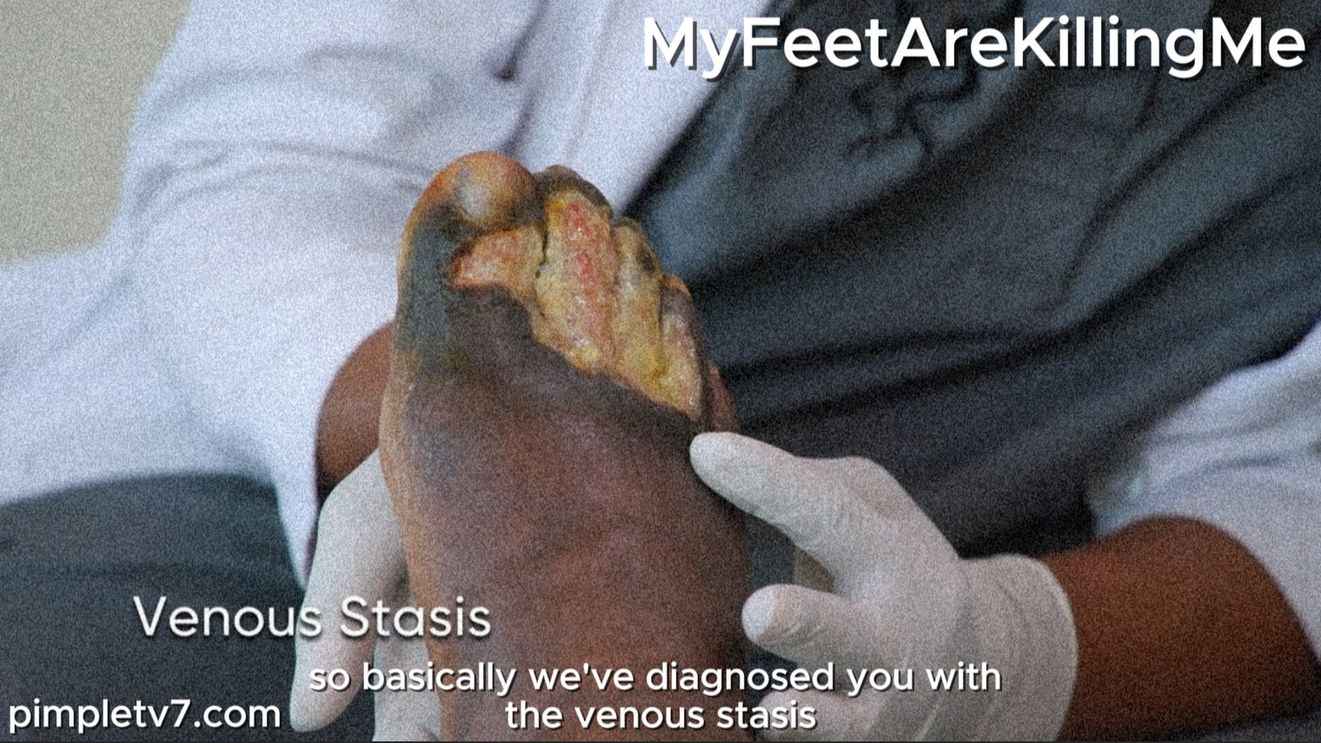 Gregory has open wounds on both feet and hopes Dr. Ebonie can heal them. MyFeetAreKillingMe 010926
