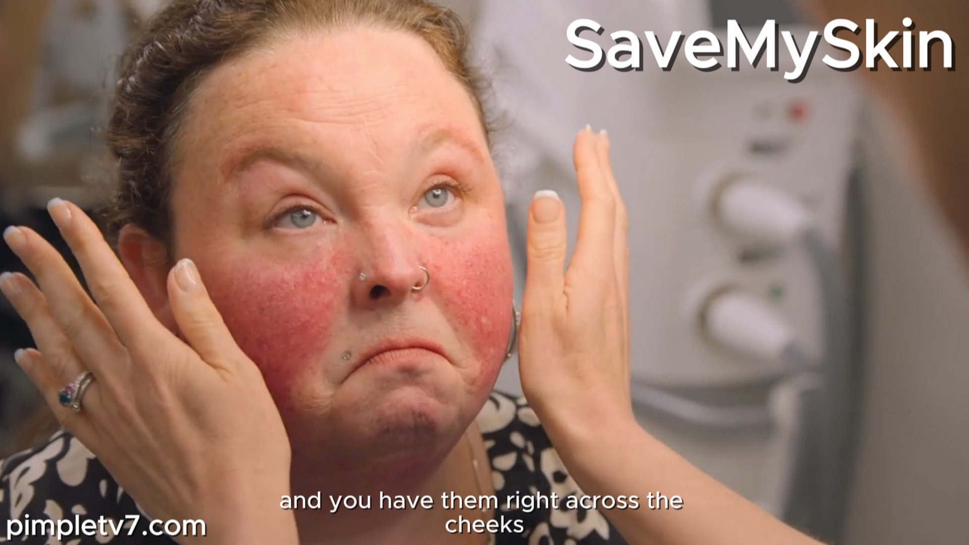 Honor has a skin condition that makes it feel like her face is on fire. SaveMySkin 290926