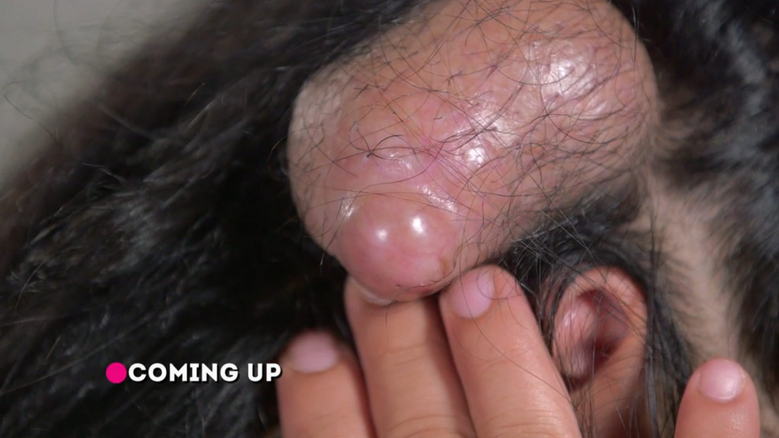 Irais’s kids are bullied because of the growth on her head. Dr. Pimple Popper 110926