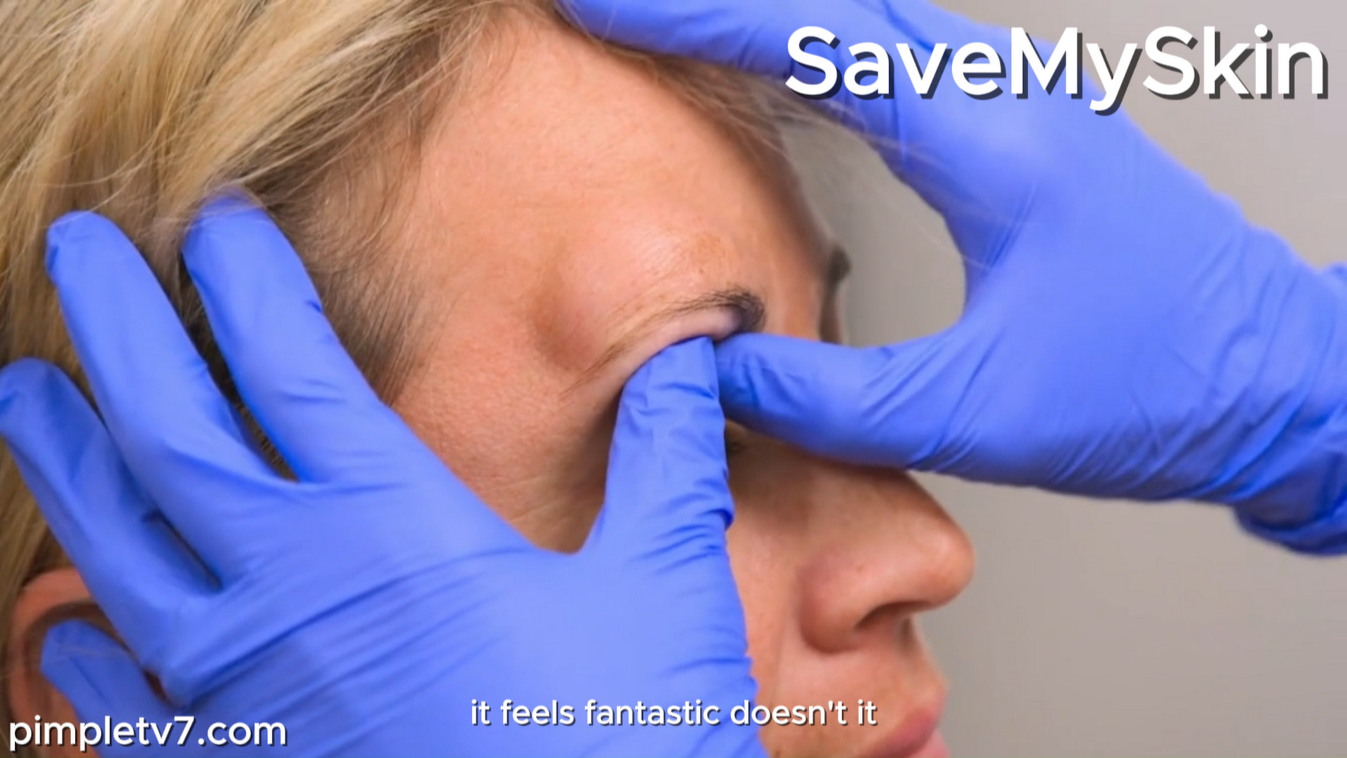 It turns out to be one of the trickiest lipomas. Dr. Emma has never removed it. SaveMySkin 130926