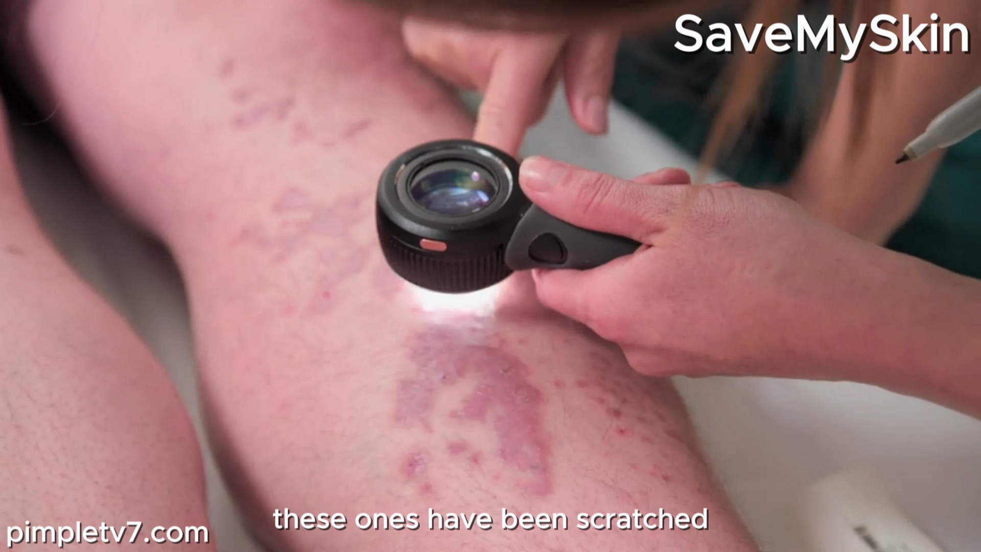 Jak’s undiagnosed skin condition has gone untreated for too long. SaveMySkin 070926