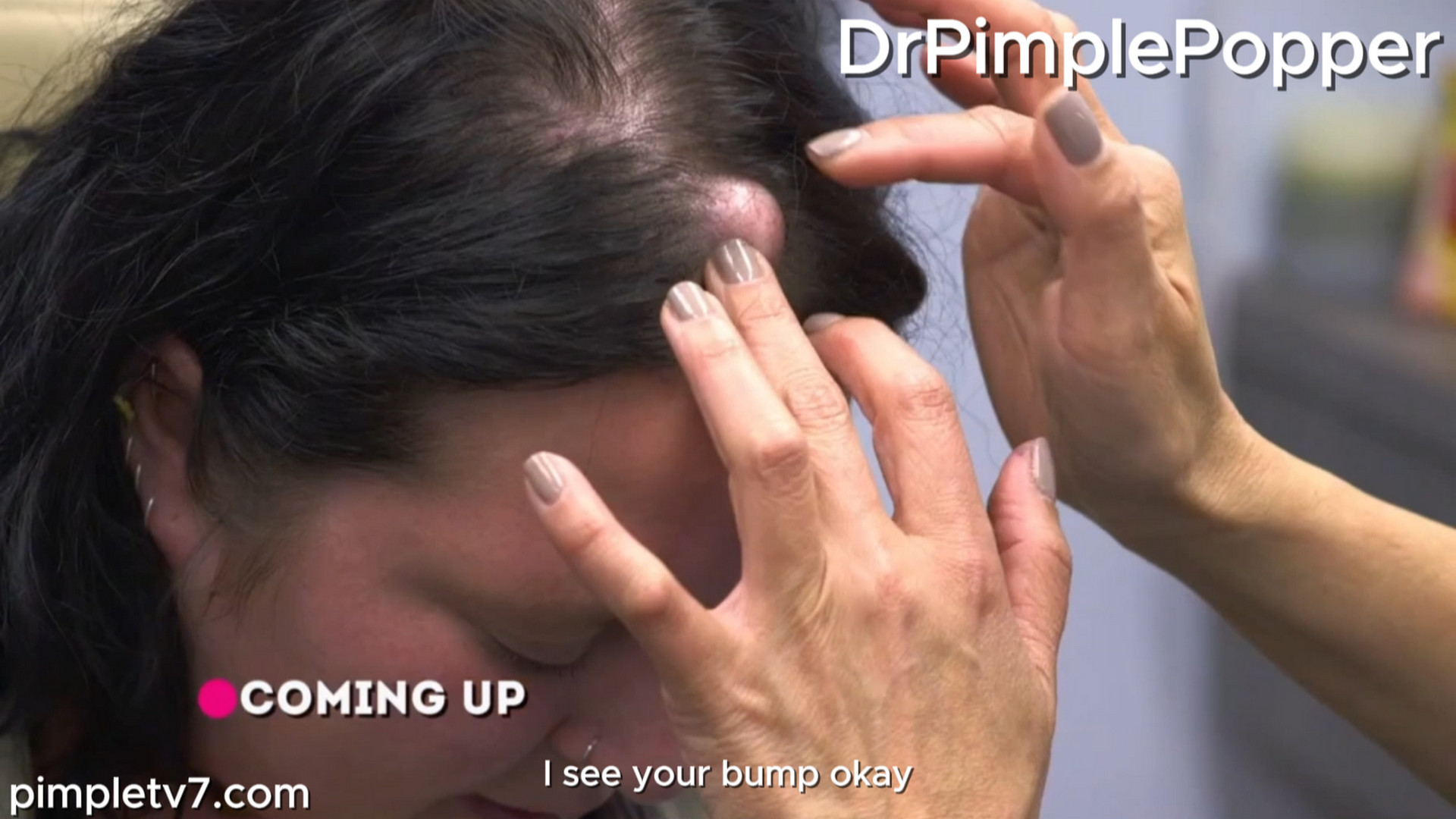 Jennifer has a unicorn bump on her forehead. Dr. Pimple Popper 090926