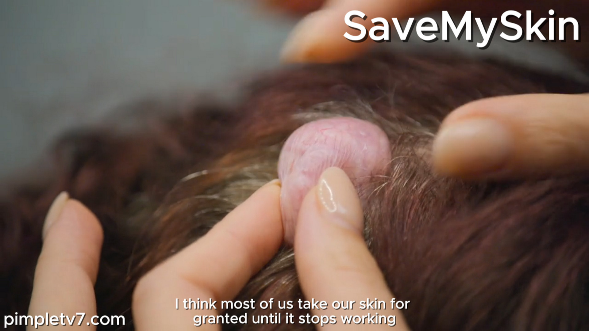 Jennifer is desperate for help with tumors caused by a rare disorder. SaveMySkin 280926