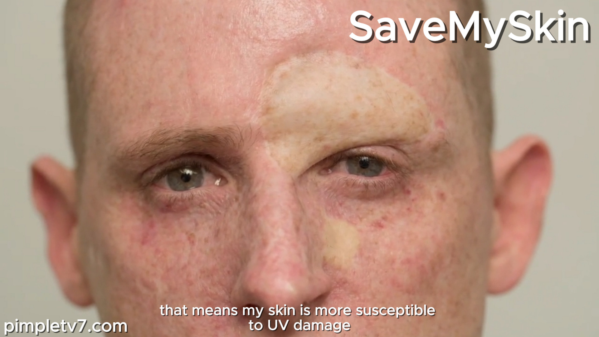 Josh comes in for an unusual procedure following life-saving cancer surgery. SaveMySkin 160926