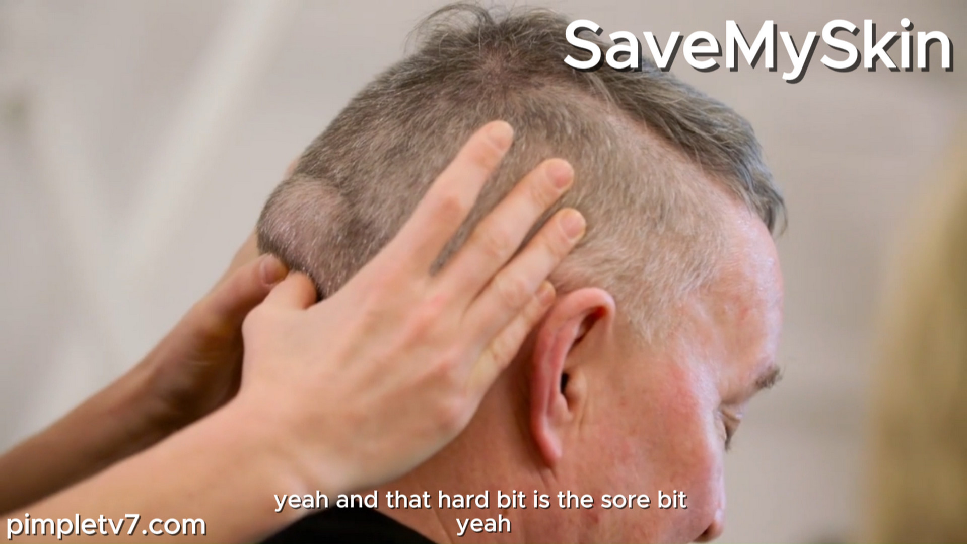 Keith has had a lump on the back of his head for 42 years. SaveMySkin 140926