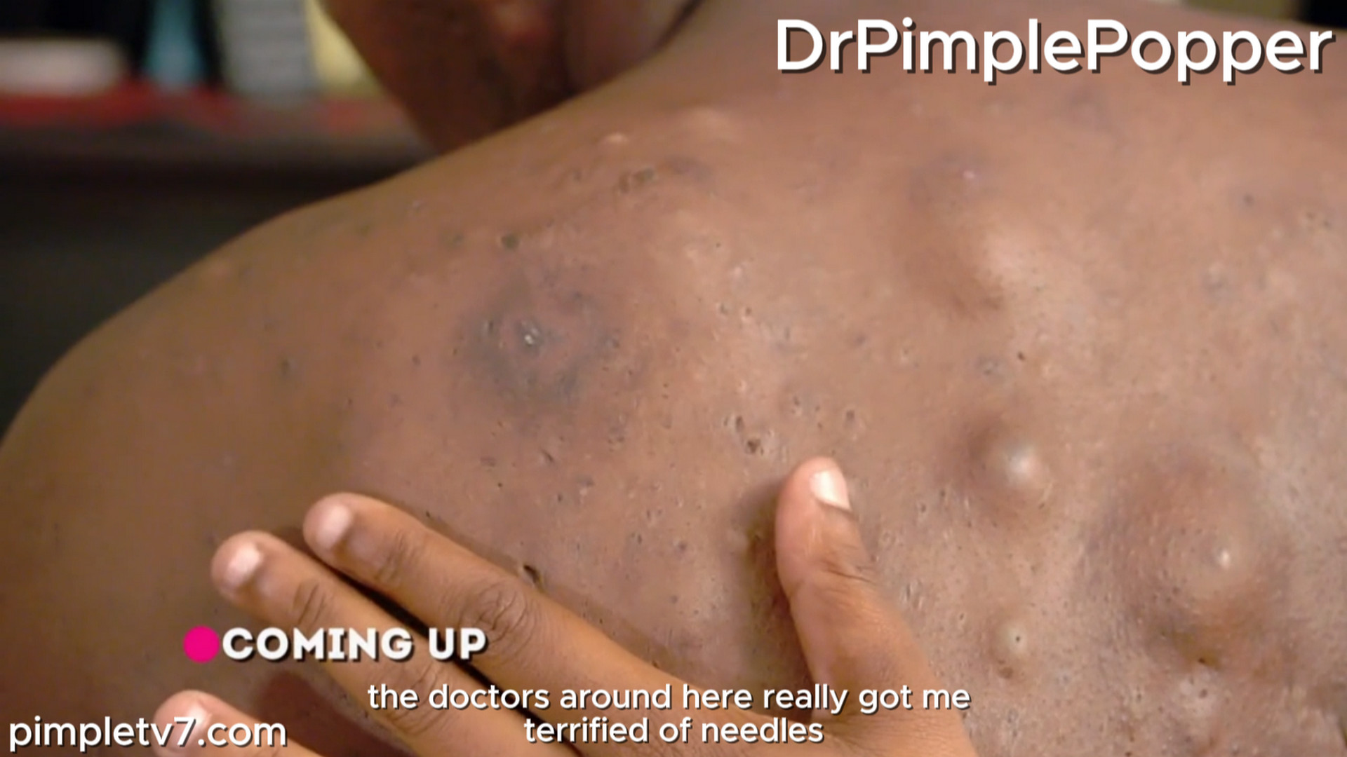 Ken is covered in painful bumps that make it difficult to do everyday things. Dr. Pimple Popper 190926