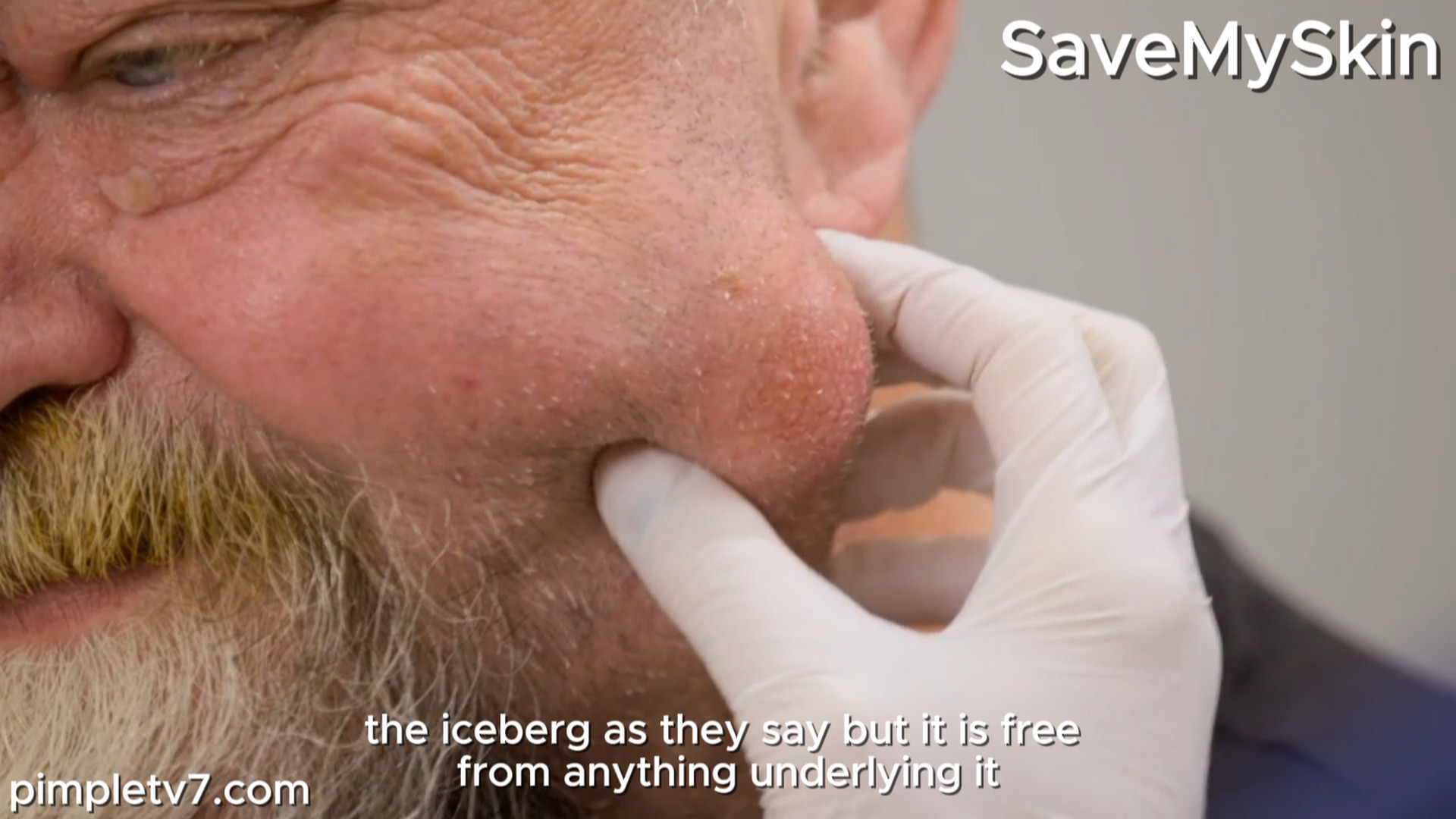 Kerrie’s lump on his face interferes with motorcycling. SaveMySkin 030926
