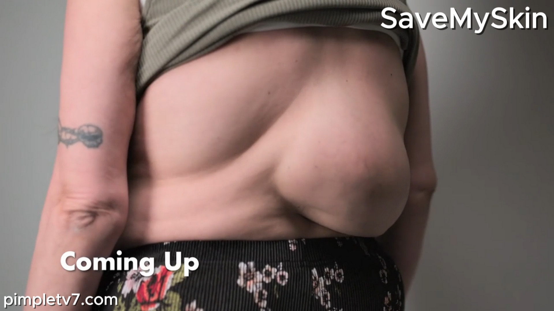Leanne’s afraid to have her 25-year-old lipoma removed. SaveMySkin 070926