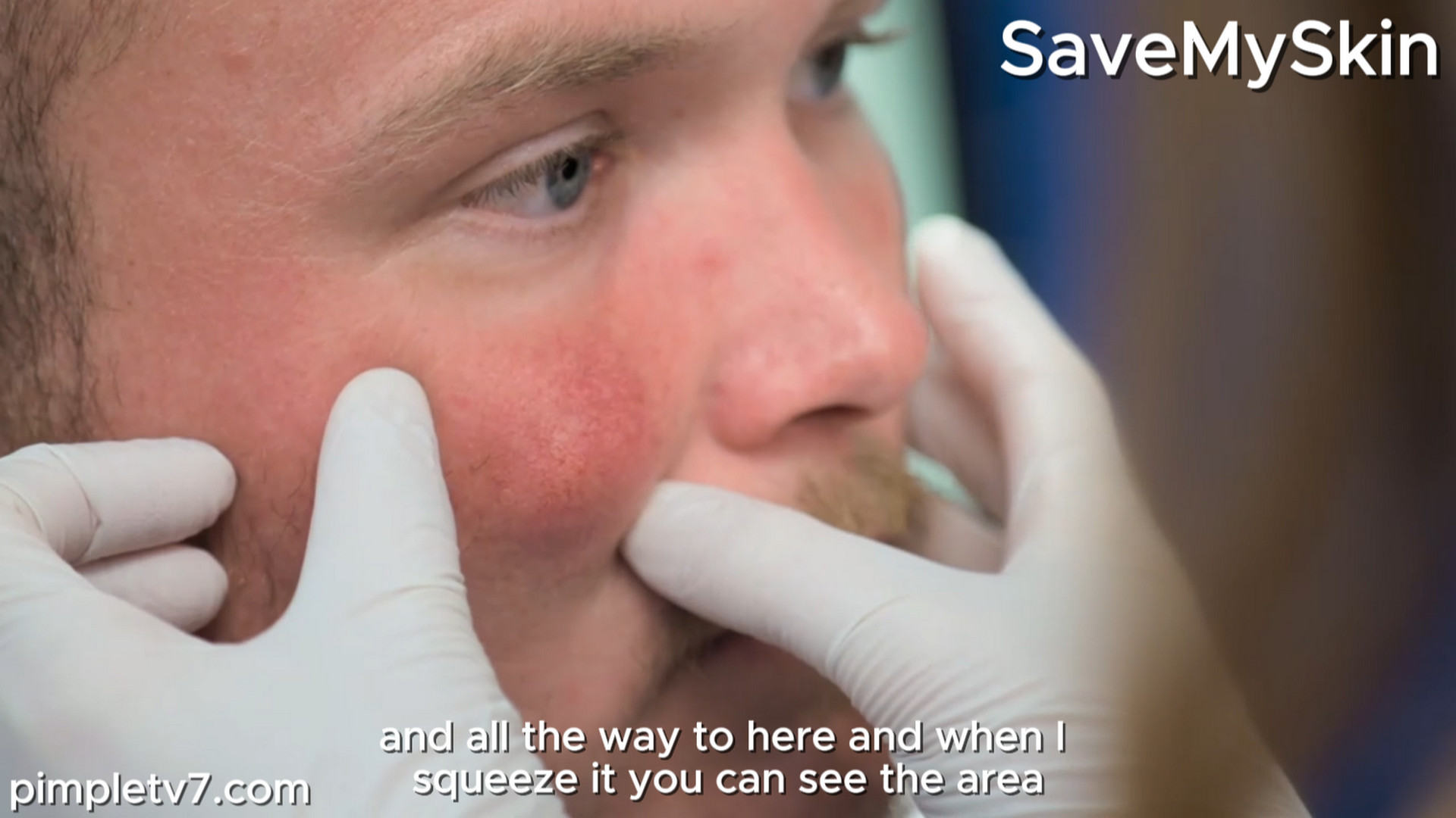 Leon has a cyst under his eye. SaveMySkin 010926