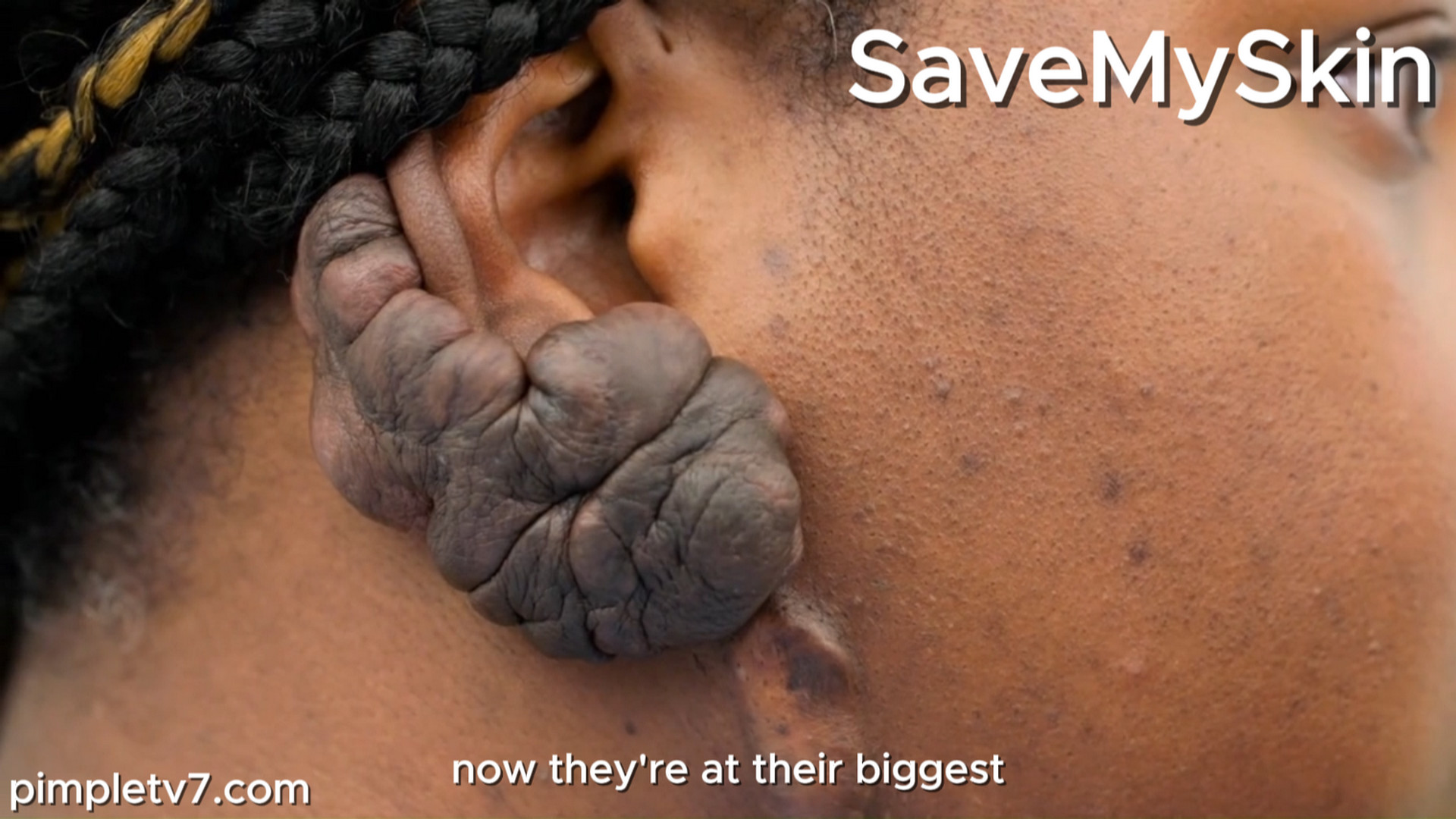Leonie has huge keloids on both ears. She had it cut off. Grown. Cut off. Now they’re at their biggest. SaveMySkin 030926
