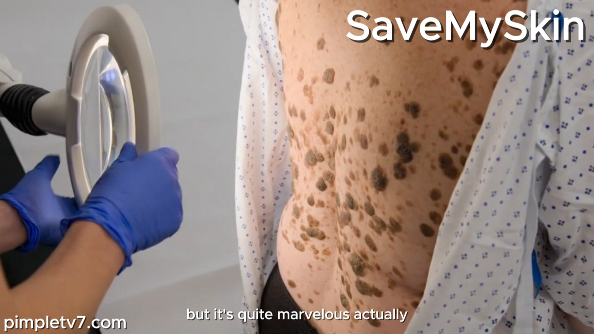 Lisa has been suffering with dark, wart-like lesions for almost three decades. SaveMySkin 060926