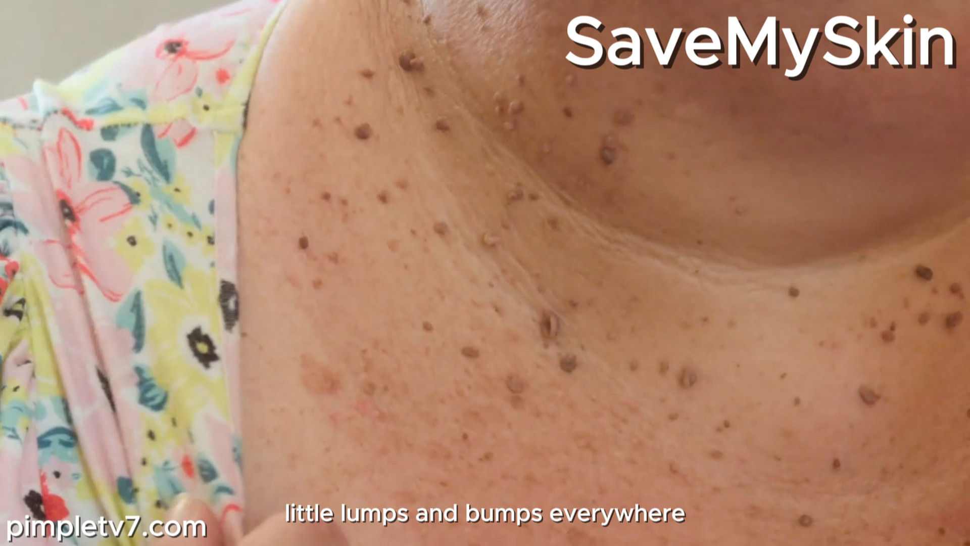 Lisa’s weight spiraled, so have hundreds of skin tags on her neck. SaveMySkin 220926