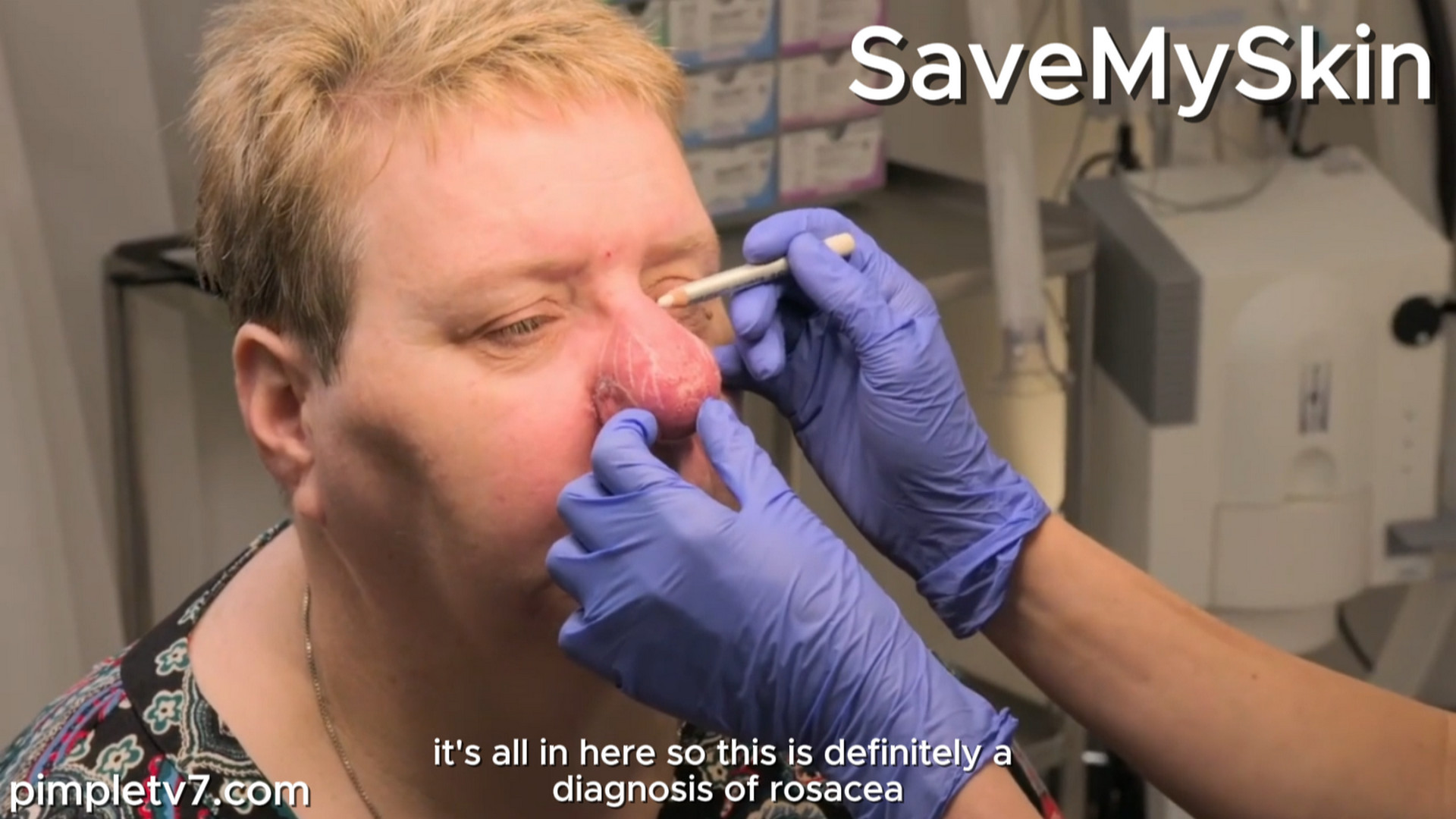 Lorna’s nose has a white bump under the skin, and that’s a small one—there’s a little cyst that’s there. SaveMySkin 110926