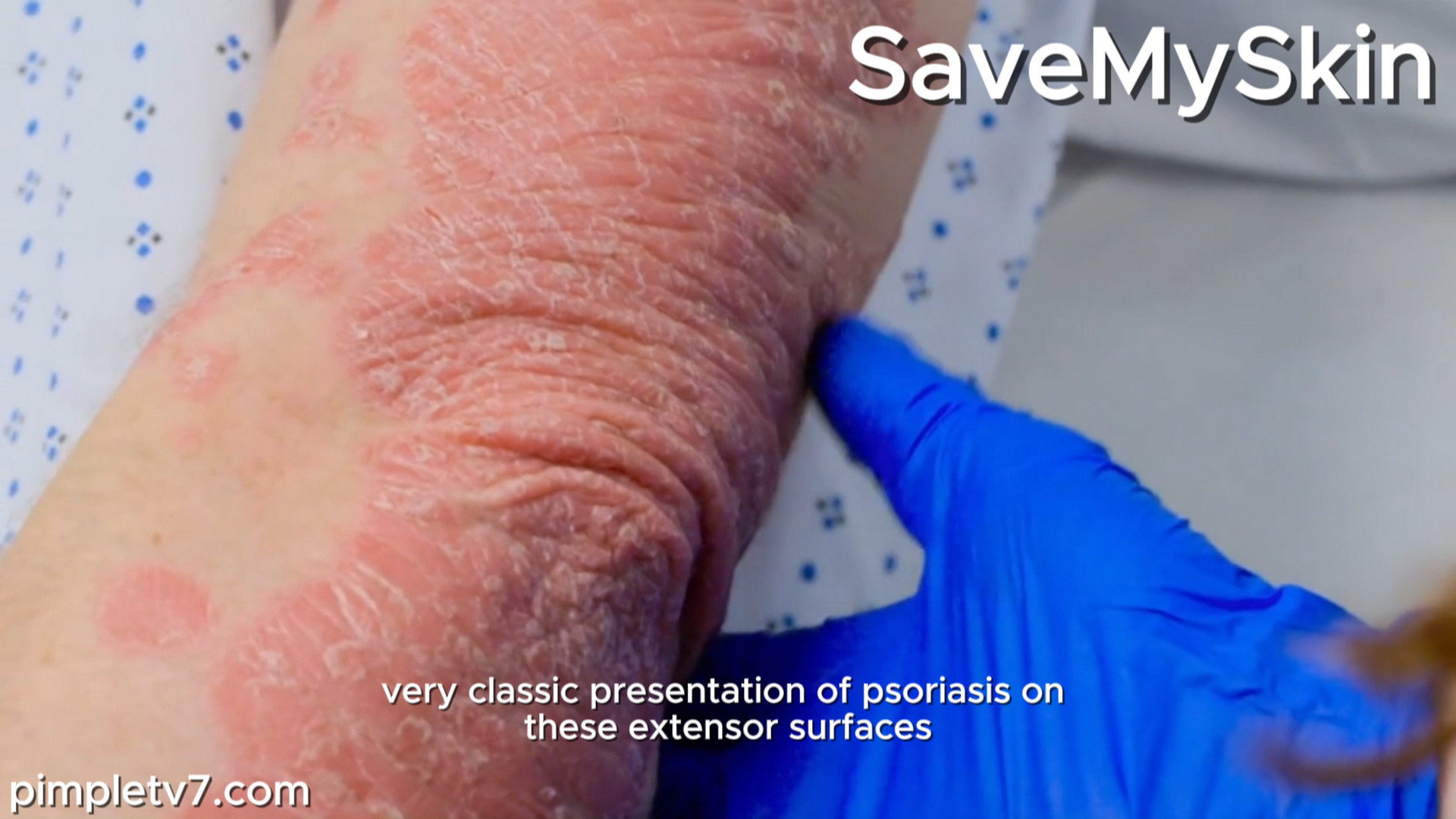 Matt’s psoriasis is so severe an infection nearly killed him. SaveMySkin 040926
