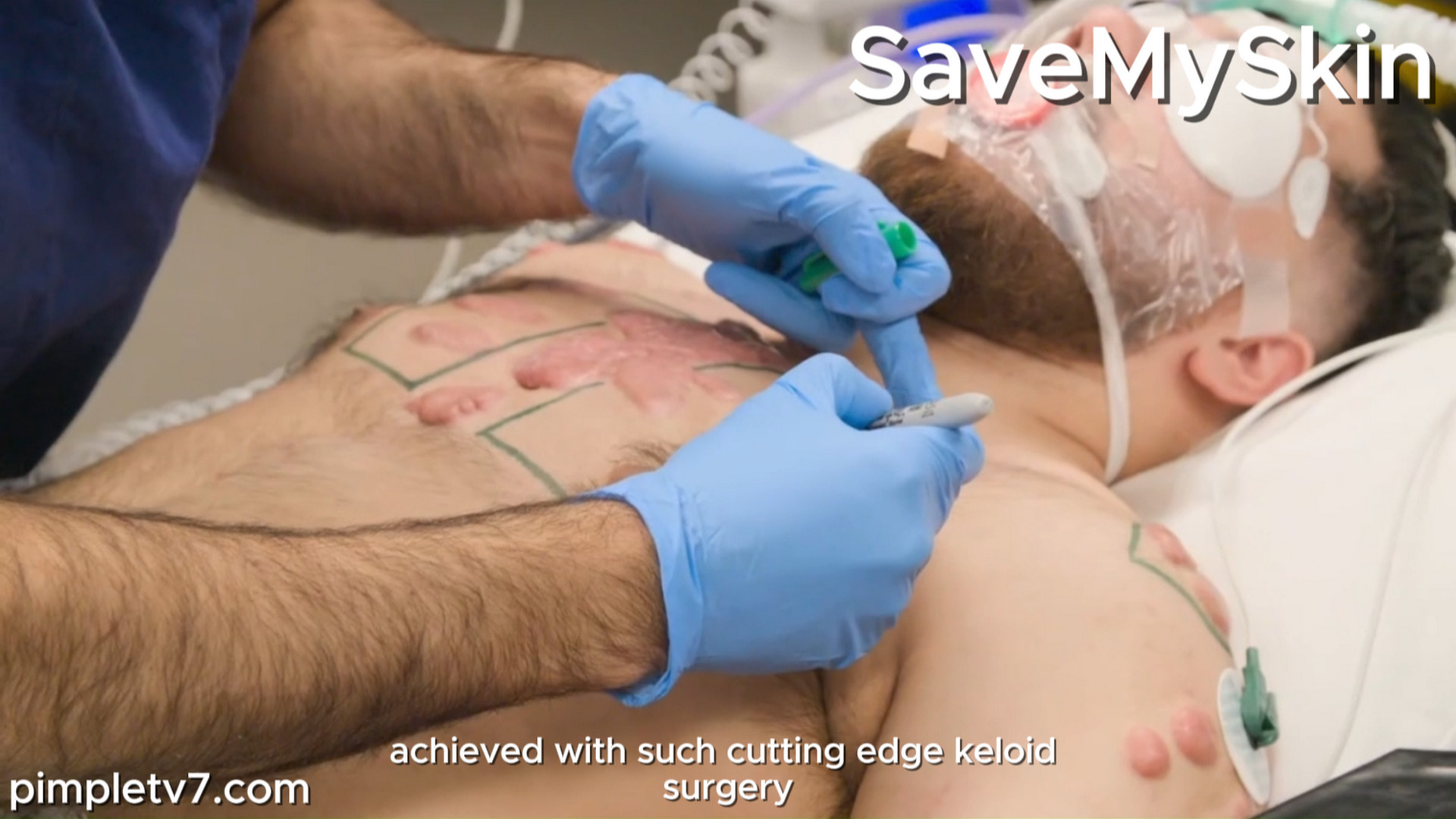 Mauricio suffers with the worst case of keloids Dr. Emma has ever seen. SaveMySkin 190926