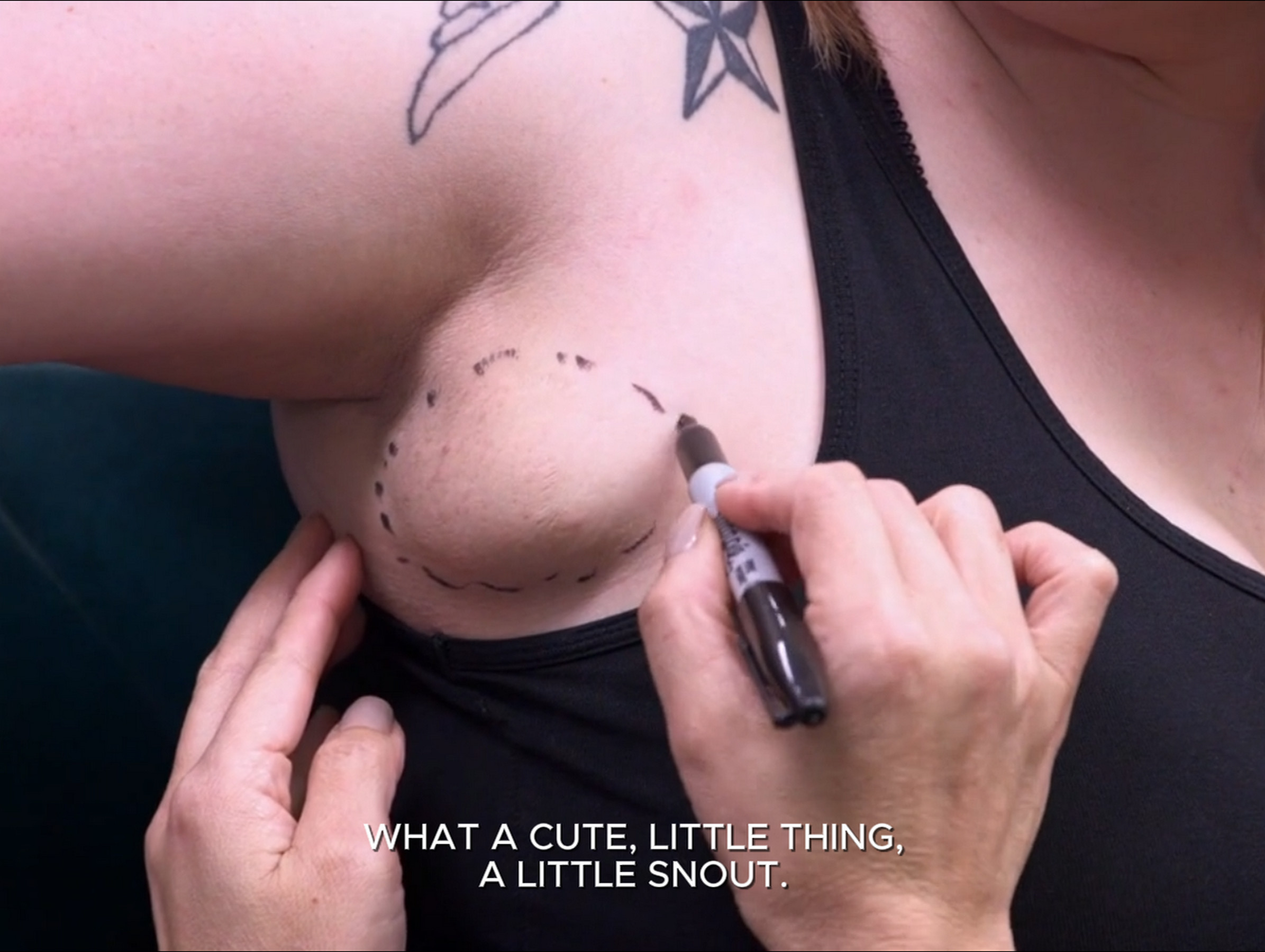 Nicole won’t get married until she has her armpit lump removed. Dr. Pimple Popper 020926