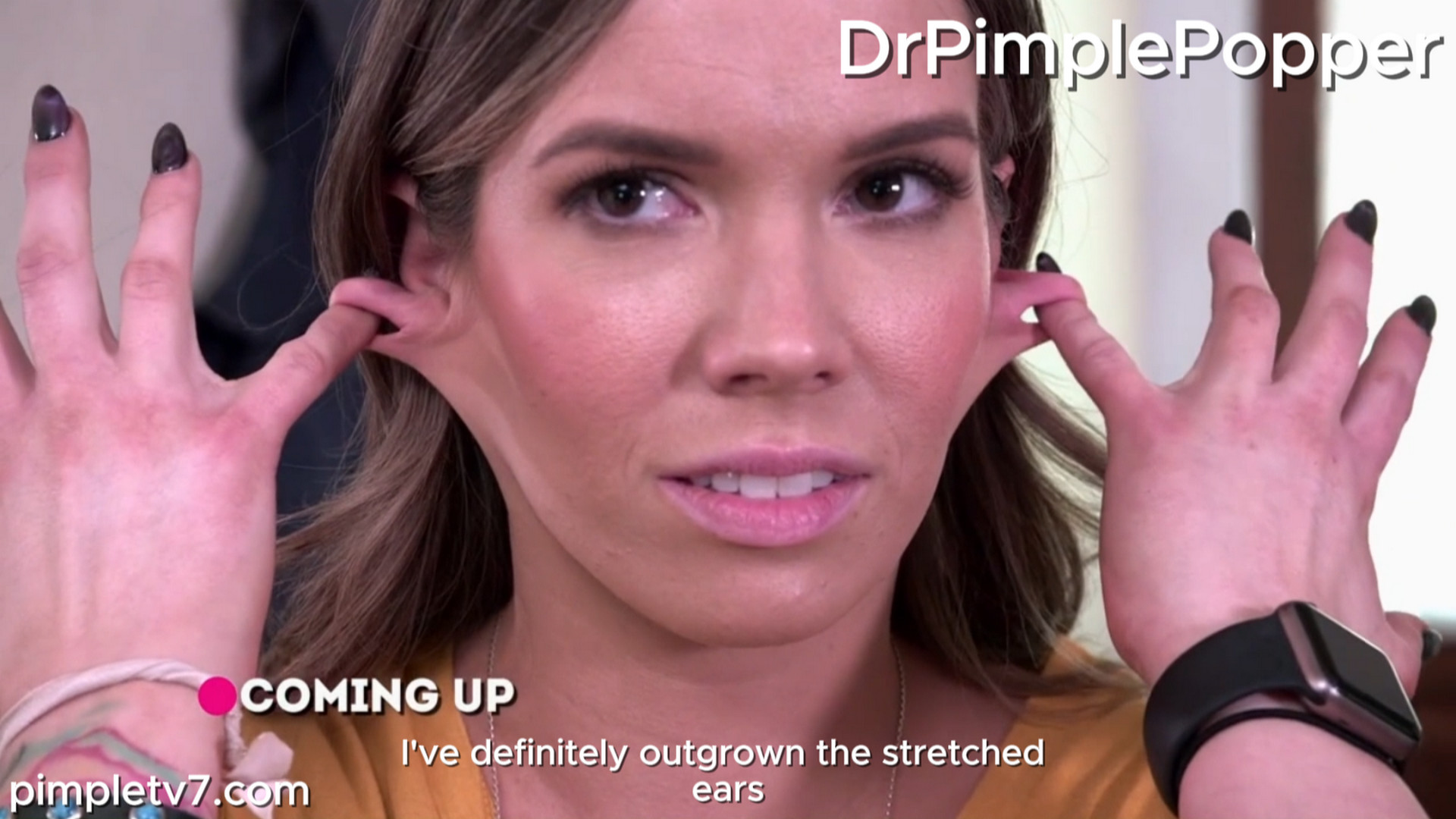 Noelle had her stretched ears repaired when she was 15 years old. Dr. Pimple Popper 030926