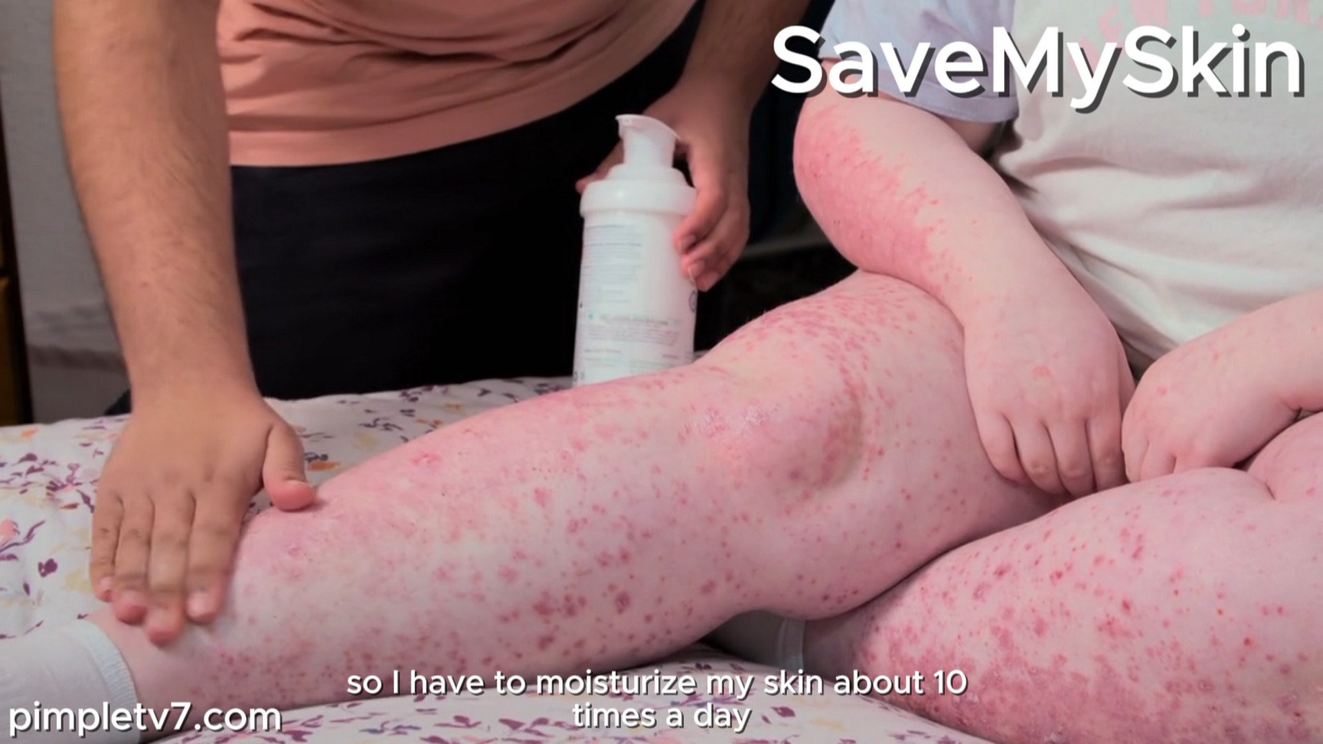 Olivia’s psoriasis, Renata’s foot condition, and Leslie’s skin tags. SaveMySkin 200926