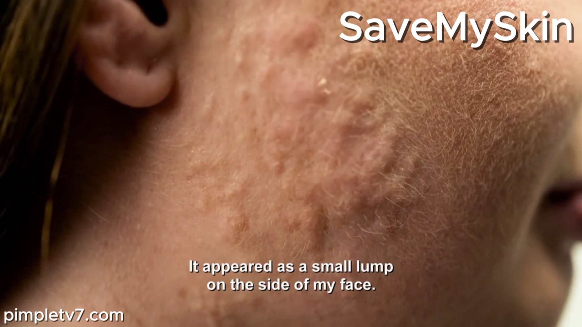 Painful, itchy lumps have been spreading across Laura’s face. SaveMySkin 010926