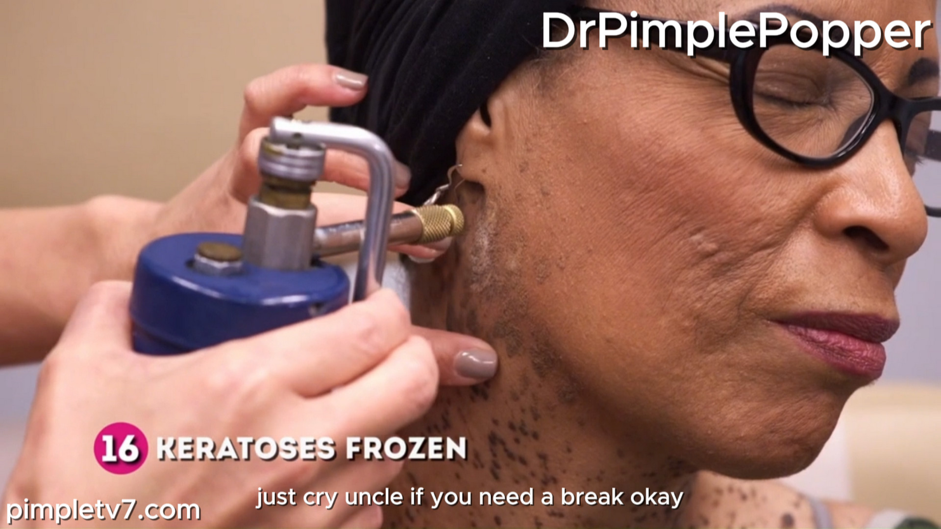 Pat has rapidly spreading moles covering her neck, temples, upper chest, and lower abdominal area. Dr. Pimple Popper 080926