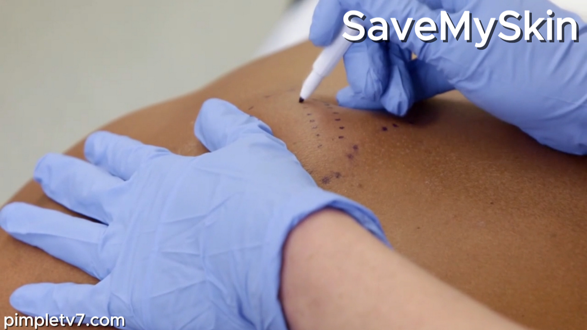 Paul has a giant lump on his back. It looks ugly, and he’s worried about it. SaveMySkin 070926