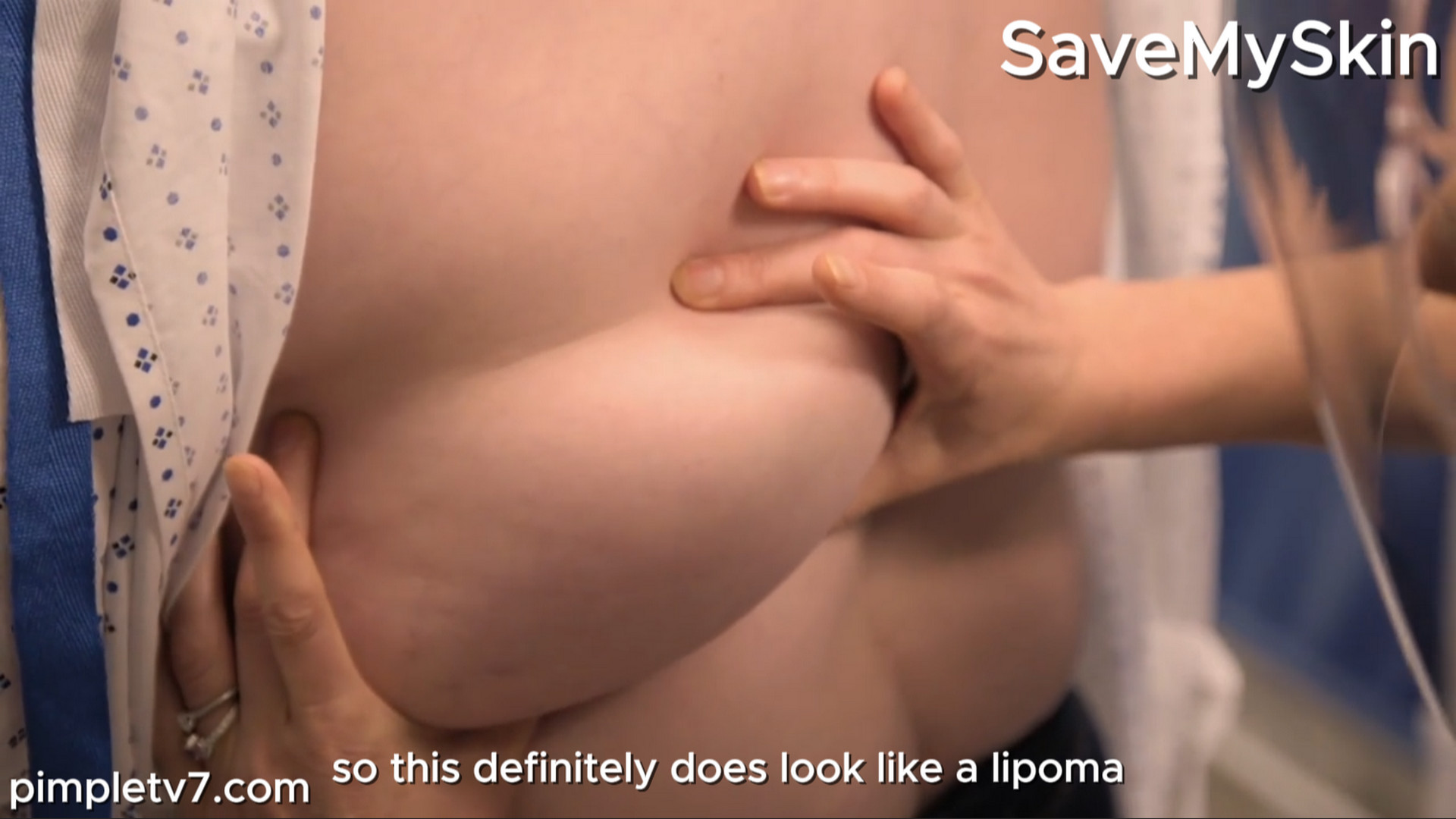 Peggy has a large lipoma on her lower back. SaveMySkin 040926