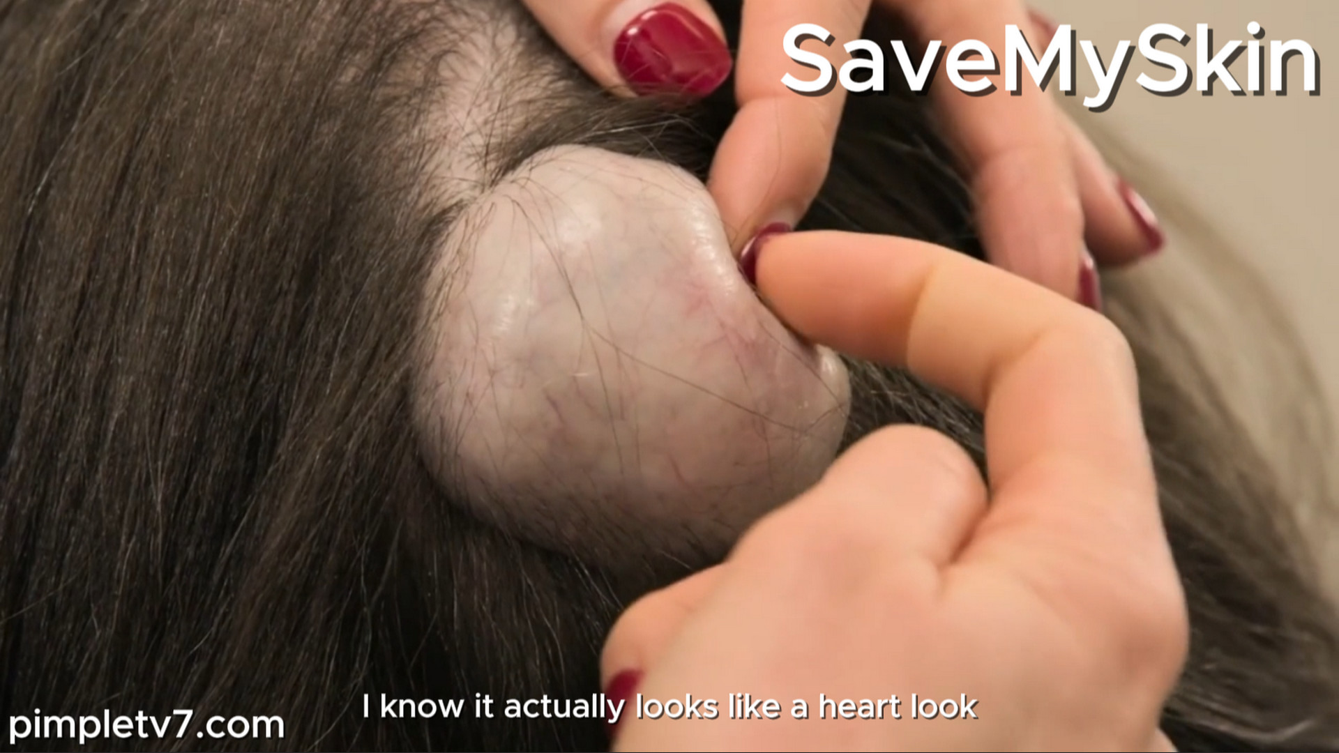 Pirkko’s pilar cyst is one of the biggest Dr. Emma has ever seen. SaveMySkin 100926