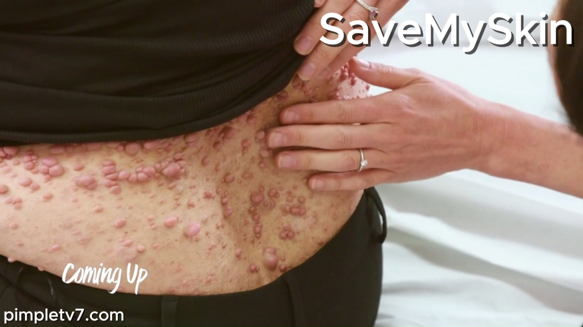 Rachael’s body is covered in hundreds of squishy bumps. SaveMySkin 060926