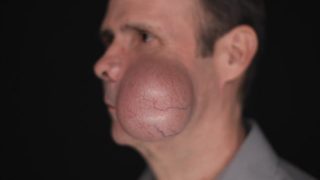 Ron Sigler, when faced with treating a man whose cheek is about to pop due to a 4 lb tumor, Dr. Panossian worries it could become a deadly situation. AboutFace 180926