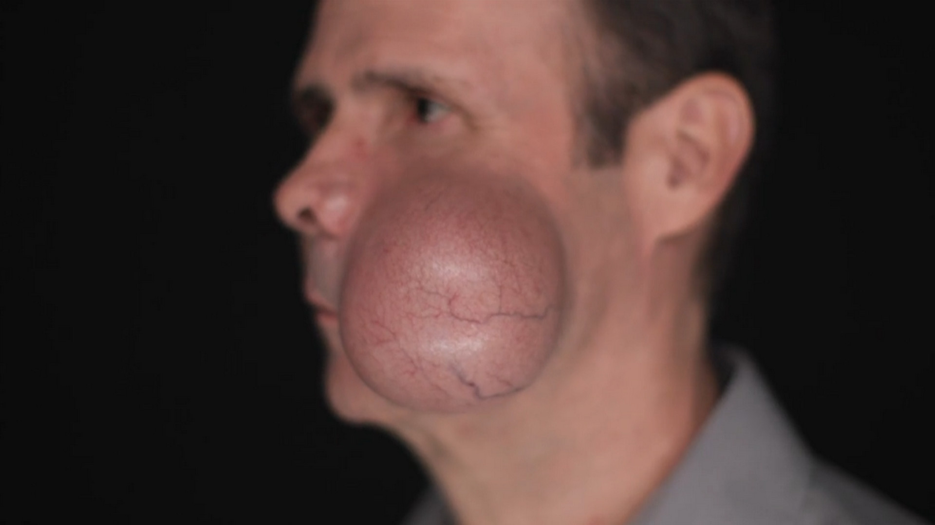 Ron Sigler, when faced with treating a man whose cheek is about to pop due to a 4 lb tumor, Dr. Panossian worries it could become a deadly situation. AboutFace 180926
