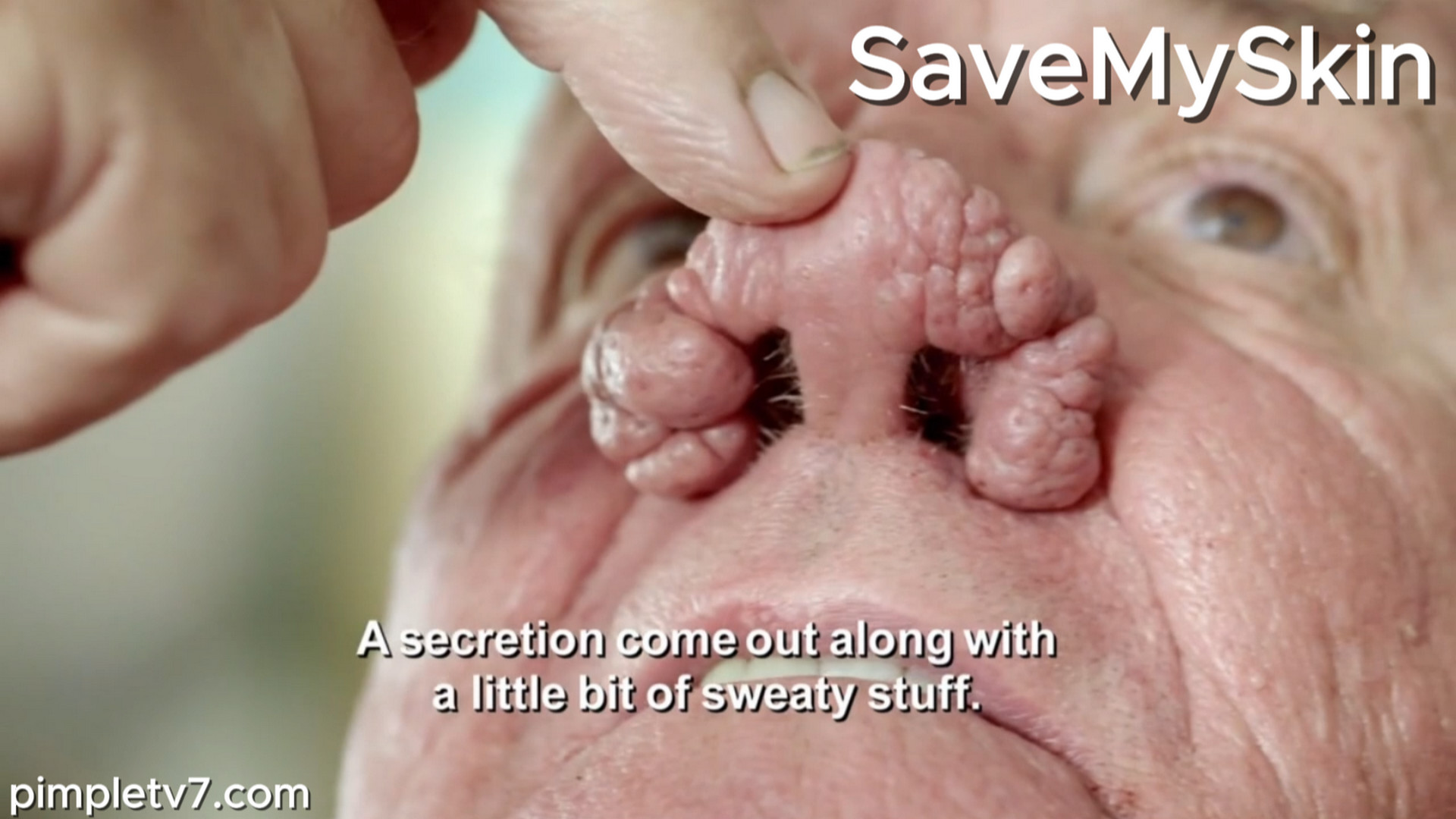 John’s nose has grown completely out of control. SaveMySkin 060926