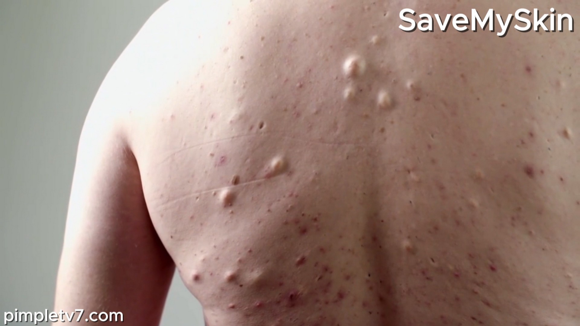 Scott’s odorous cysts are ruining his life. SaveMySkin 020926
