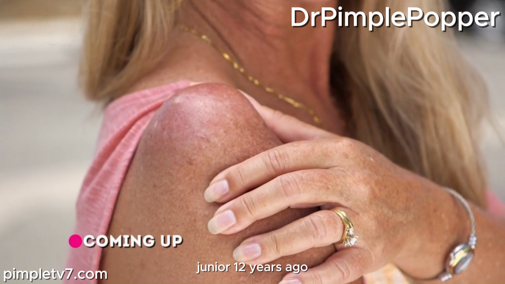 Sisters Cheri and Janice both suffer from matching lumps. Dr. Pimple Popper 140926
